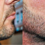 Will a Beard Transplant Leave Scars? What You Need to Know