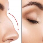  Rhinoplasty Nose Cost: A Comprehensive Guide