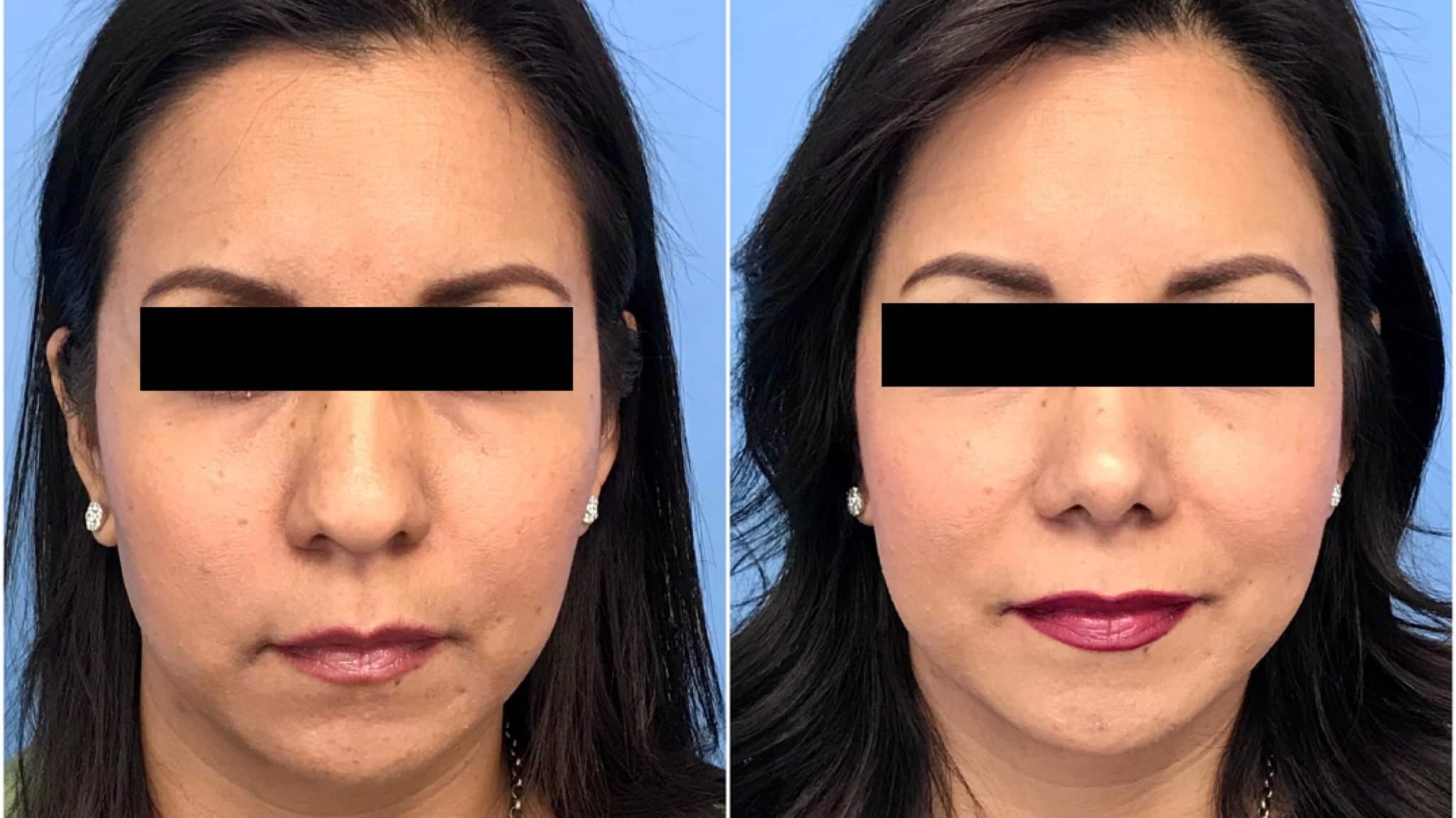 Bulbous Tip Nose Surgery Texas