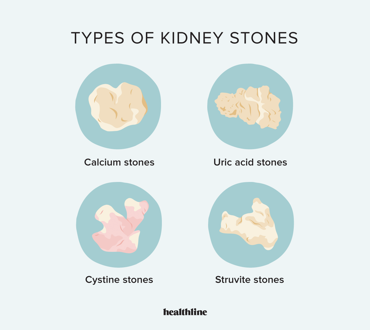 Kidney Stone Size Chart: Stone Sizes, Symptoms, and Treatment Options