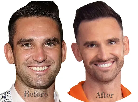 Bad veneers before and after